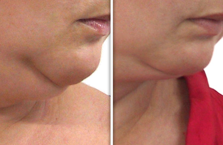 Gıdı sarkması nasıl giderilir?