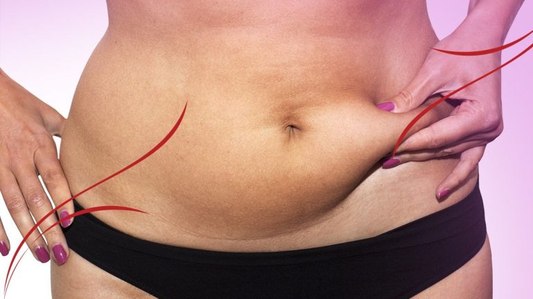 Karındaki sarkma ve gevşemeler için ne yapılıyor?