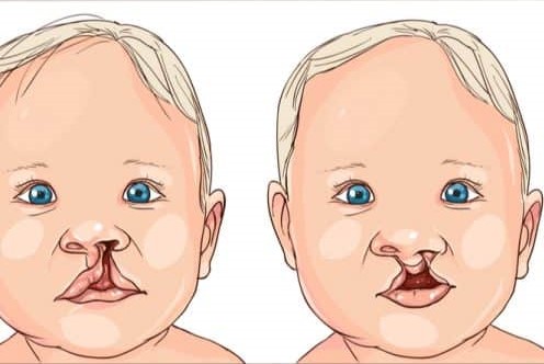 Dudak  yarıkları gelişimi olumsuz etkiliyor